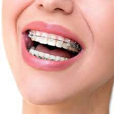 Orthodontic Treatment